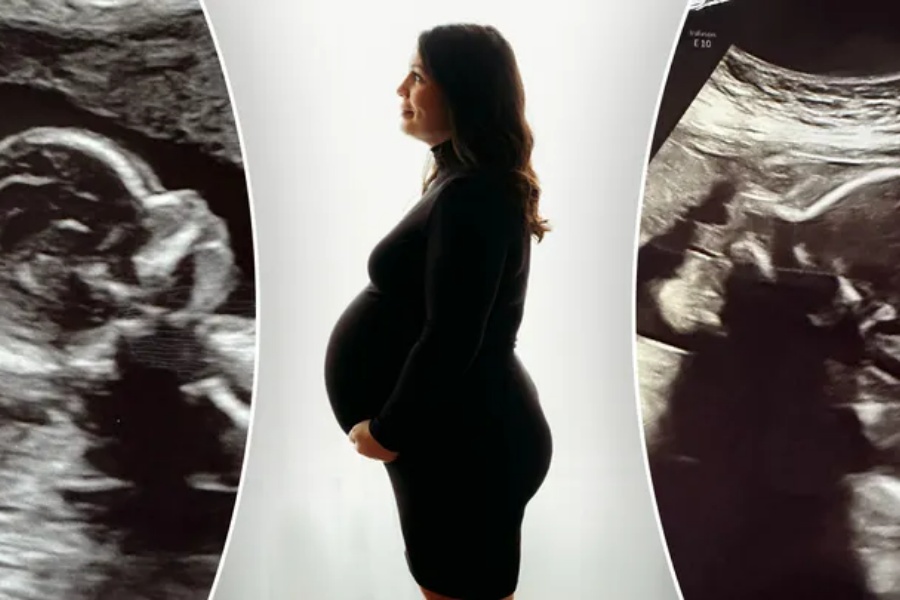 दुई पाठेघर भएकी महिला गर्भवती, दुवै पाठेघरमा स्वस्थ भ्रूण