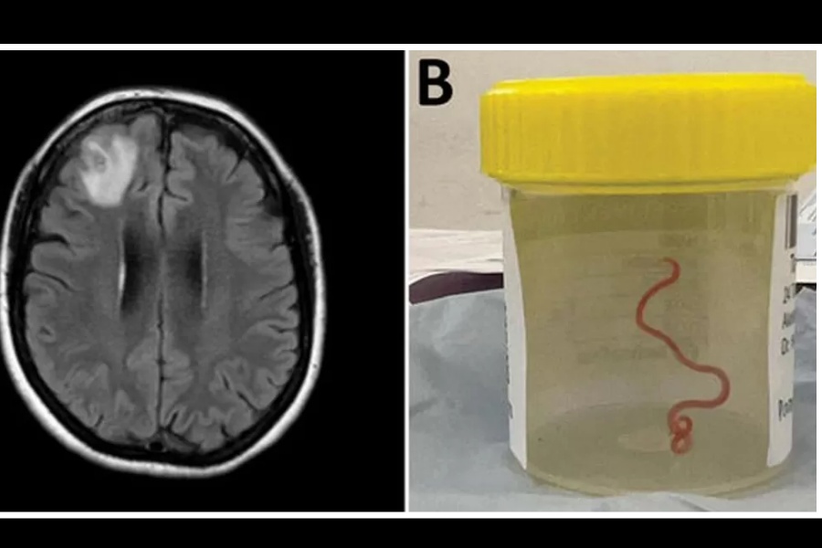 विश्वमै पहिलोपटक भेटियो मानव मस्तिष्कमा जीवित कीरा