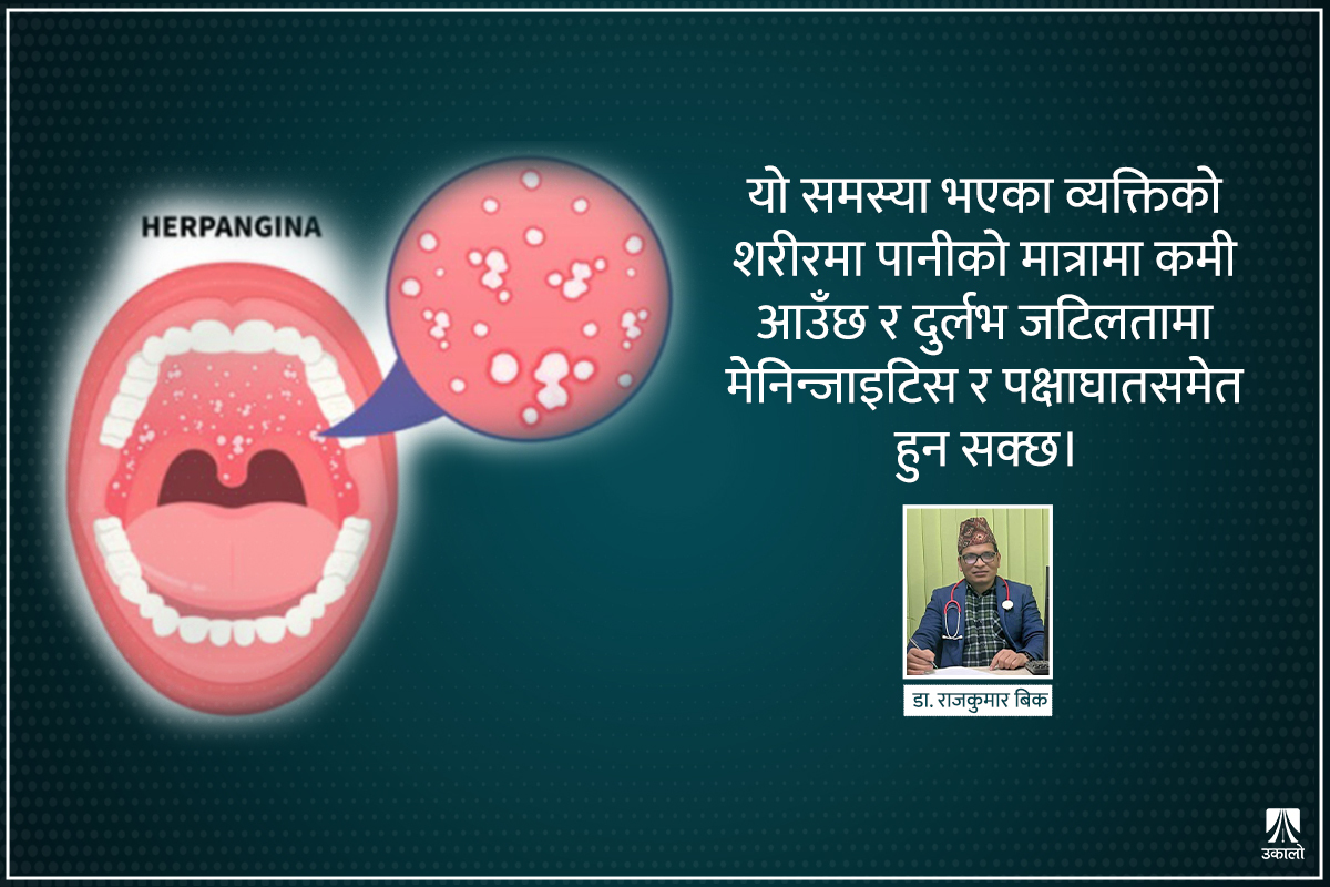 के हो बालबालिकामा लाग्ने हर्पेन्जिना? 