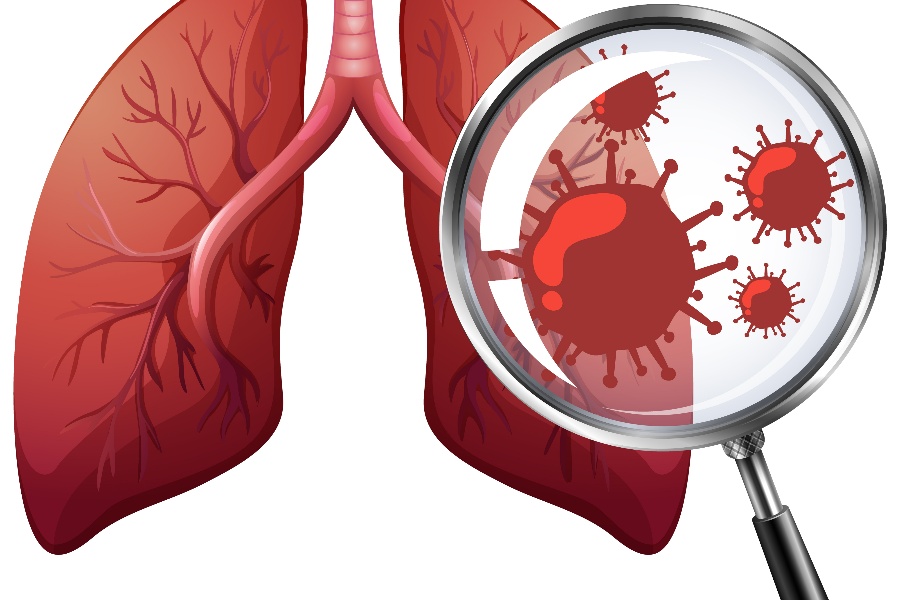 आधाभन्दा बढी क्षयरोग बिरामी उपचारको पहुँचबाहिर
