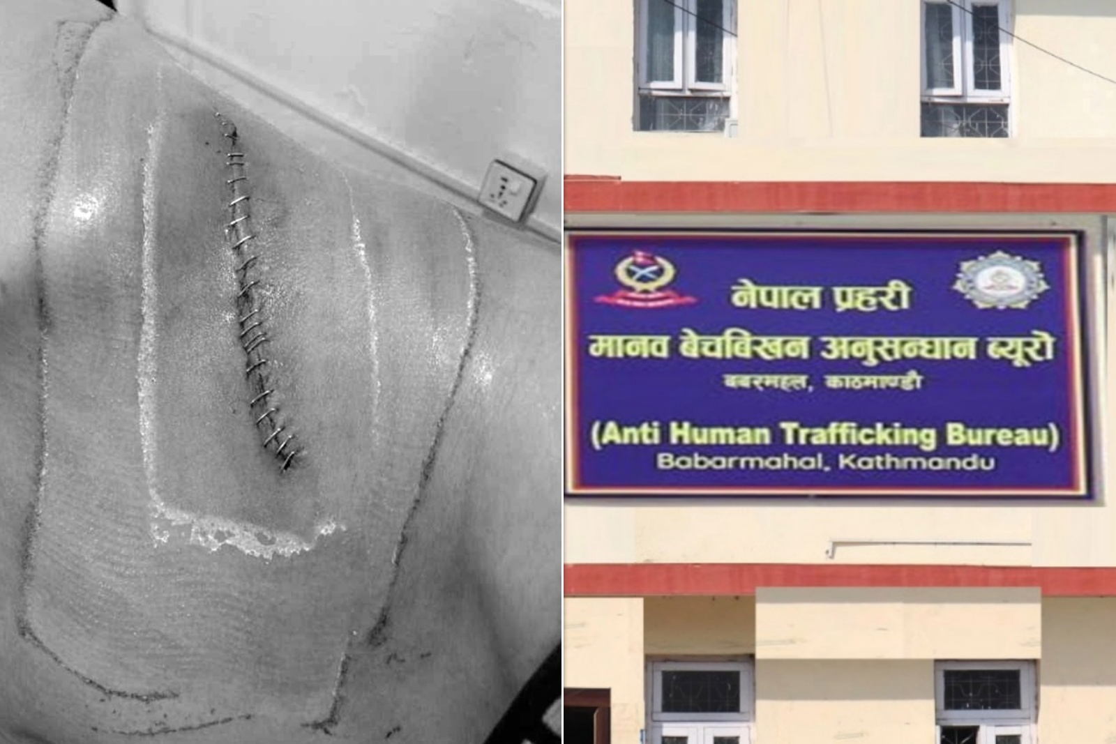 पहिले आफ्नो मिर्गौला बेचे, पछि आफू नै त्यो गिरोहमा जोडिए