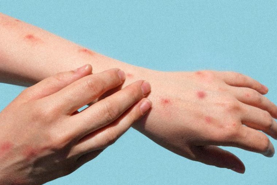 थप एक नेपालीमा मंकीपक्स पुष्टि